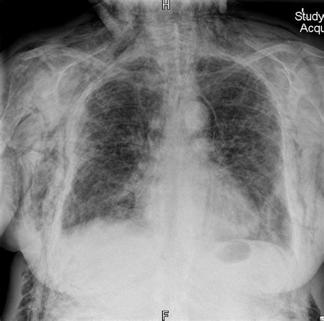 Subcutaneous Emphysema X Ray