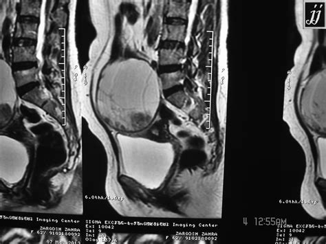 Radioogle Abdomen Abnormal Ovarian Hemorrhagic Cyst Rare Case