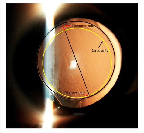 Post Operative Anterior Segment Photography With Dilated Pupil The Download Scientific