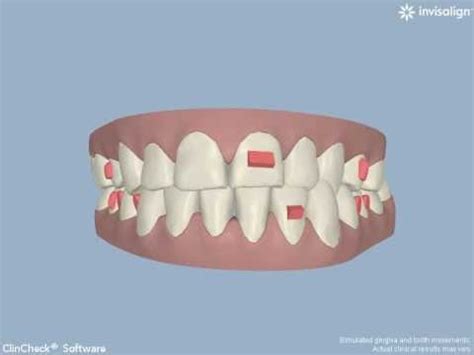 Invisalign Crossbite Treatment - YouTube