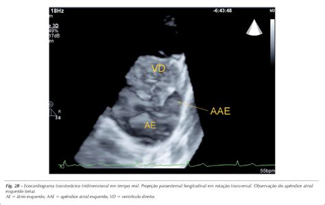 Scielo Brasil Ap Ndice Atrial Esquerdo Imagem Ecocardiogr Fica