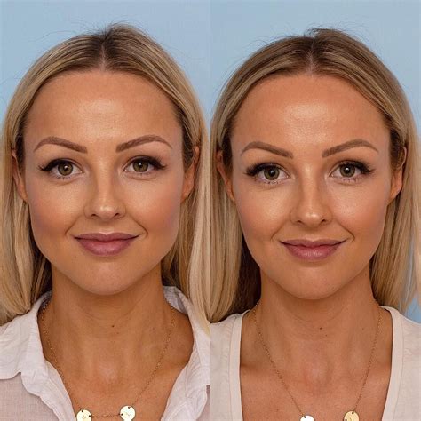 Top 97 Pictures Before And After Pictures Of Botox Around The Mouth