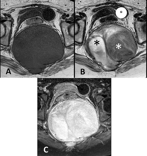 Axial T1 A T2 B And T1 Postcontrast Fat Suppressed C Sequences