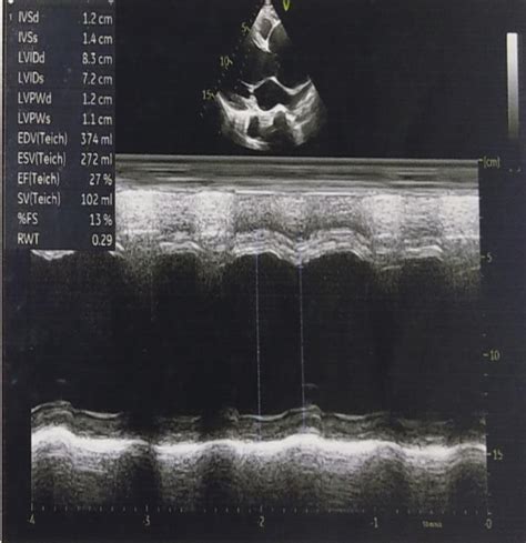 Modified Bentalls Procedure For Annuloaortic Ectasia With Severe Left