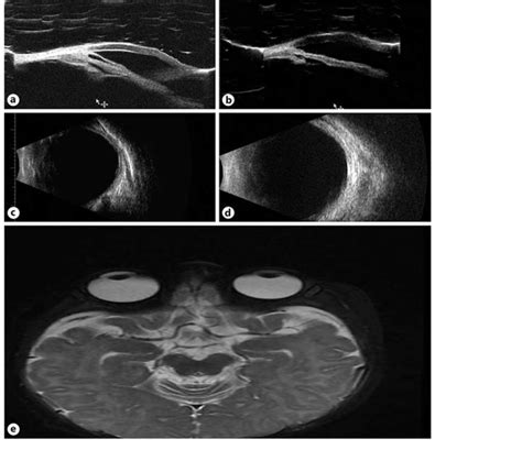 A B Ultrasound Biomicroscopy Of The Right And Left Eyes Respectively