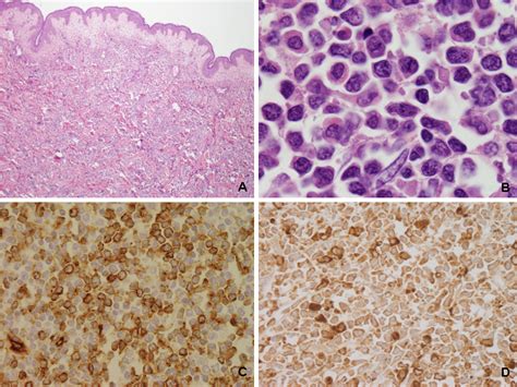 Skin Biopsy Diagnosis Of Langerhans Cell Neoplasms Intechopen