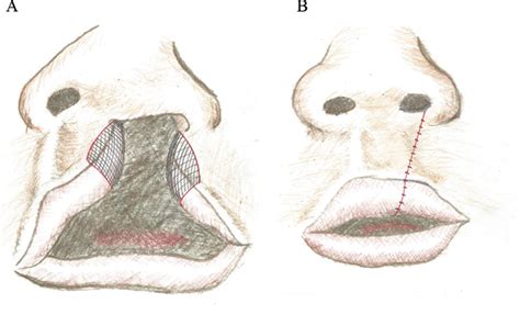 The Surgical Technique For The Complete Unilateral Cleft Lip Nasal Deformity