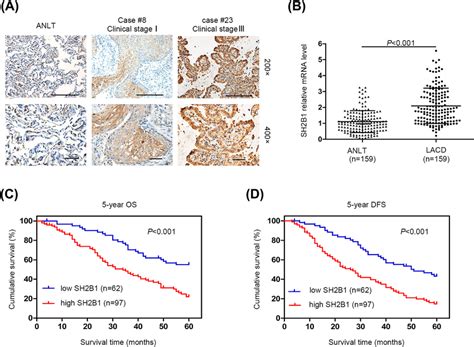 Increased SH2B1 Expression Correlates With LADC Progression A IHC