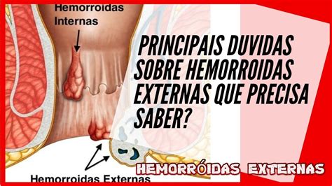 Hemorroidas Externas Saiba A Verdade Sobre As Hemorroidas Externas