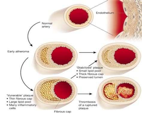 CARDIO Part 2 Pathophysiology Flashcards Quizlet