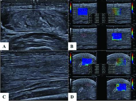 POS1233 CLINICAL SEROLOGICAL AND MUSCLE SHEAR WAVE ELASTOGRAPHY