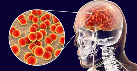 Qu Es La Meningitis As Ptica Cu Les Son Sus S Ntomas Y Cu L Es Su