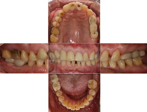 Intraoral Views At Post Orthodontic State A Maxillary Occlusal View