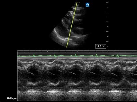 Pericardial Effusion And Metastasis Critical Care Sonography