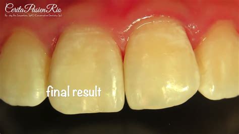 Midline Anterior Teeth Caries Restoration Penambalan Gigi Depan Youtube