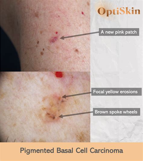 Superficial Basal Cell Carcinoma Early Stages