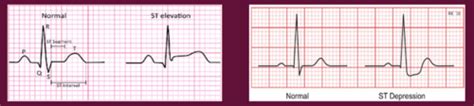 Diagnostic studies- ST segment changes Flashcards | Quizlet