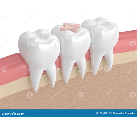 D Render Of Teeth With Dental Inlay Filling Stock Illustration