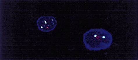 Dual Colour Fish With Centromeric Chromosome Probe Green And Tp