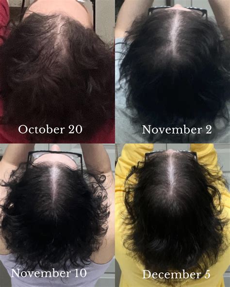 3 Months Progress Topical Minoxidil And Dutasteride R Femalehairloss