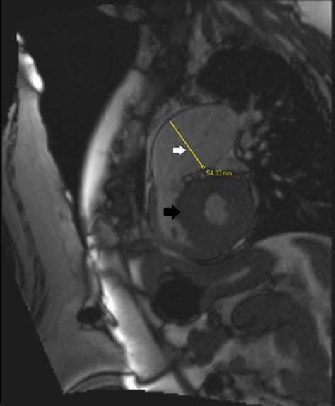 Cardiac Mri Imaging For Rvot Dilatation The Measured Length Of 54 33 Download Scientific