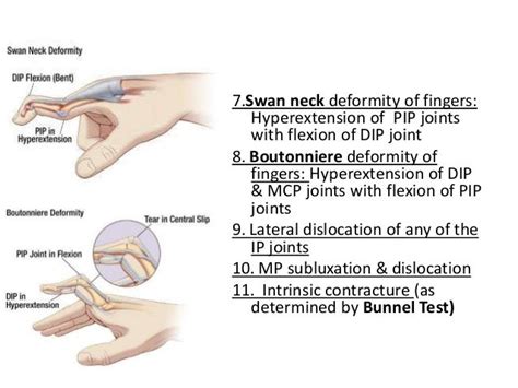 Rheumatoid Arthritis For Undergraduates