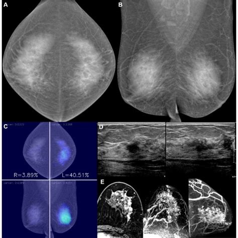 A 55 Year Old Woman With Invasive Lobular Carcinoma In The Left Breast Download Scientific