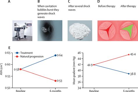 Treatment Of Severe Symptomatic Aortic Valve Stenosis Using Non