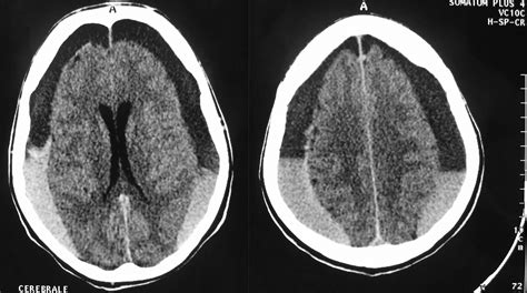 Bilateral Chronic Subdural Haematoma Misdiagnosed As Neuroleptic