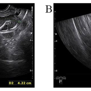 Threedimensional Transvaginal Ultrasound A Transvaginal Ultrasound