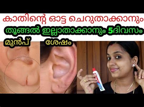 കതനറ തങങൽ ഇലലതകകന ഓടട കറകകന How to reduce ear hole