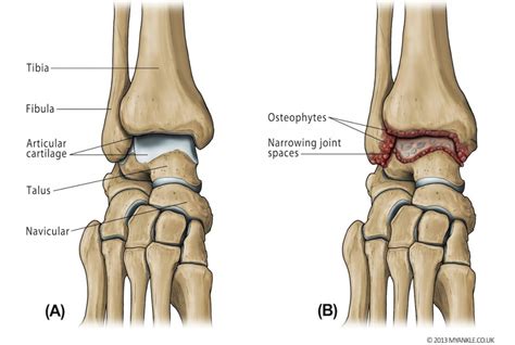 Types of arthritis that affects the knees - kneesafe.com