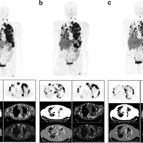 68 Ga DOTATOC PET CT In A Metastatic Insular TC At Baseline A And