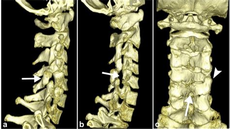 Absent Cervical Spine Pedicle And Associated Congenital Spinal