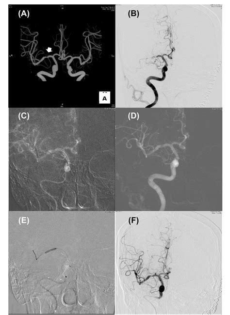 Endovascular Therapy For Acute Ischemic Stroke Of Intracranial