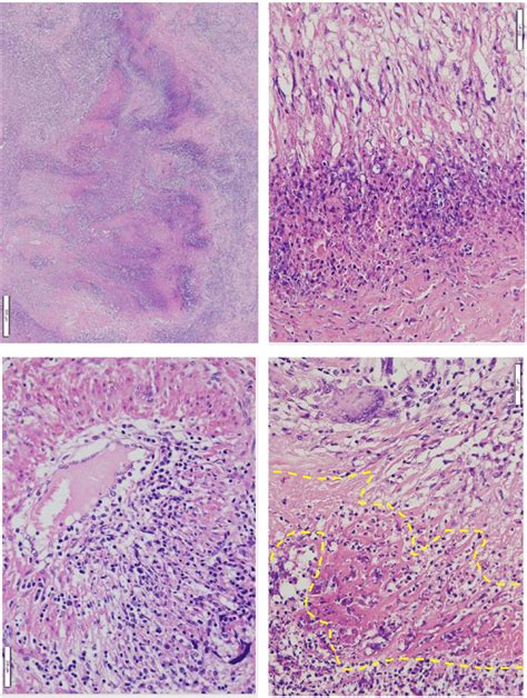 A Poorly Formed Granuloma With Geographic And Basophilic Necrosis Download Scientific