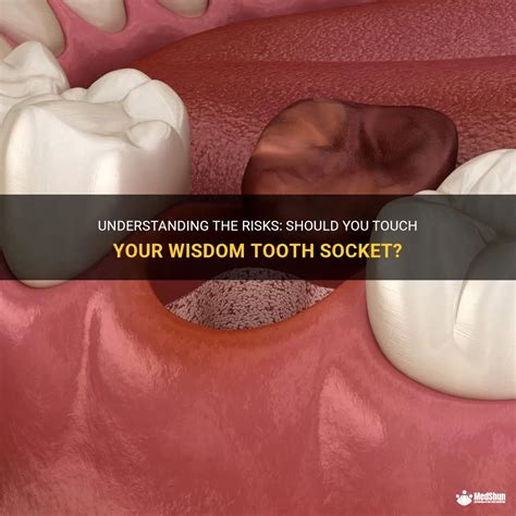 Understanding The Risks Should You Touch Your Wisdom Tooth Socket Medshun