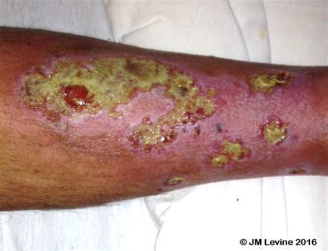 Pseudomonas Aeruginosa Burn Infection