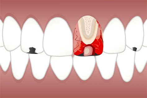 Qu Es La Pulpitis S Ntomas Tipos Y Tratamientos Coi Clinica Dental