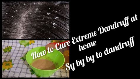 Say By By To Dandruffbest Remedy For Extreme Dandruffhow To Get Rid