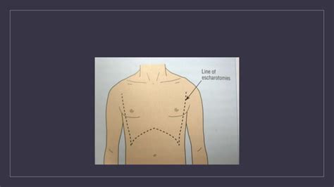 Fasciotomy And Escharotomy Ppt