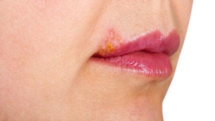 Herpes Labiale Cause Sintomi E Cure Dal Dentista