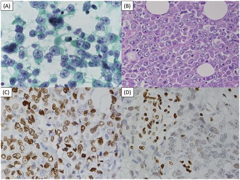 Cytopathological Features Of SMARCA4 Deficient Thoracic Sarcoma Report