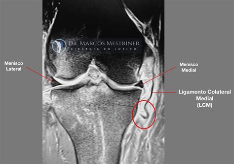 Lesão Do Ligamento Colateral Medial Do Joelho Entendendo E Tratando Dr Marcos Mestriner