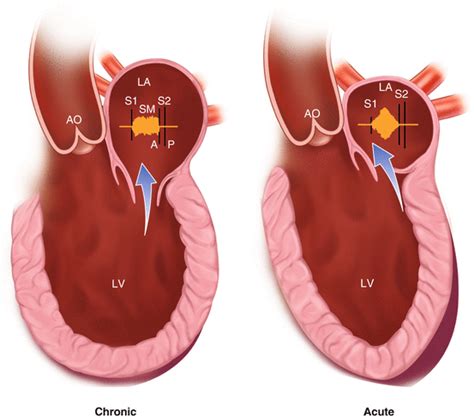 Mitral Regurgitation Thoracic Key