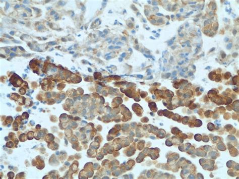 primary goblet cell carcinoid tumor staining positive
