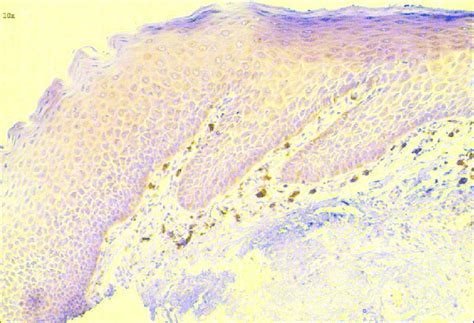 Photomicrograph of severe epithelial dysplasia shows faint positivity... | Download Scientific ...