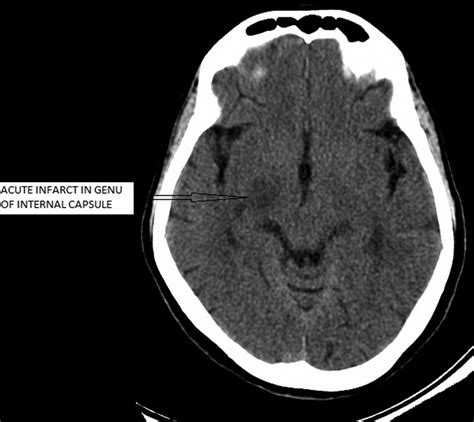Simultaneous Occurrence Of Internal Capsule Infarct And Cerebellar