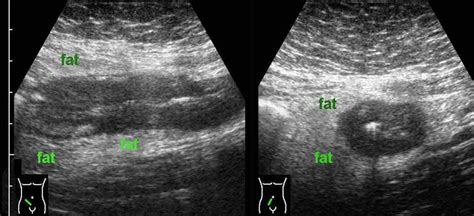 Crohn's Disease Ultrasound