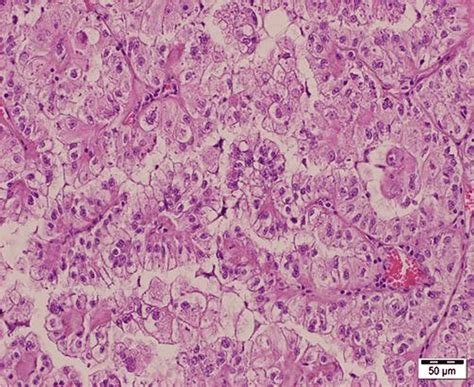 Papillary Renal Cell Carcinoma Type Papillary Structures Covered